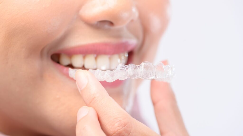 A Patient’s Guide to Straightening Teeth with Clear Aligners