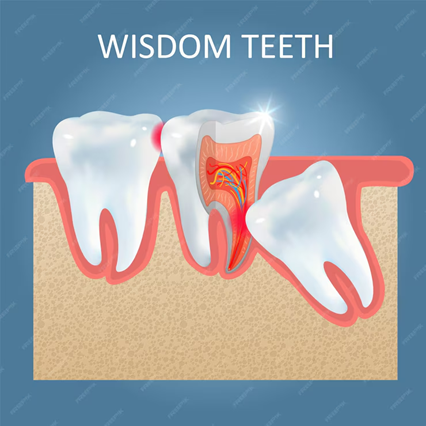 Navigating Wisdom Tooth Extraction: Your Guide to Smooth Recovery and Lifestyle Adjustments